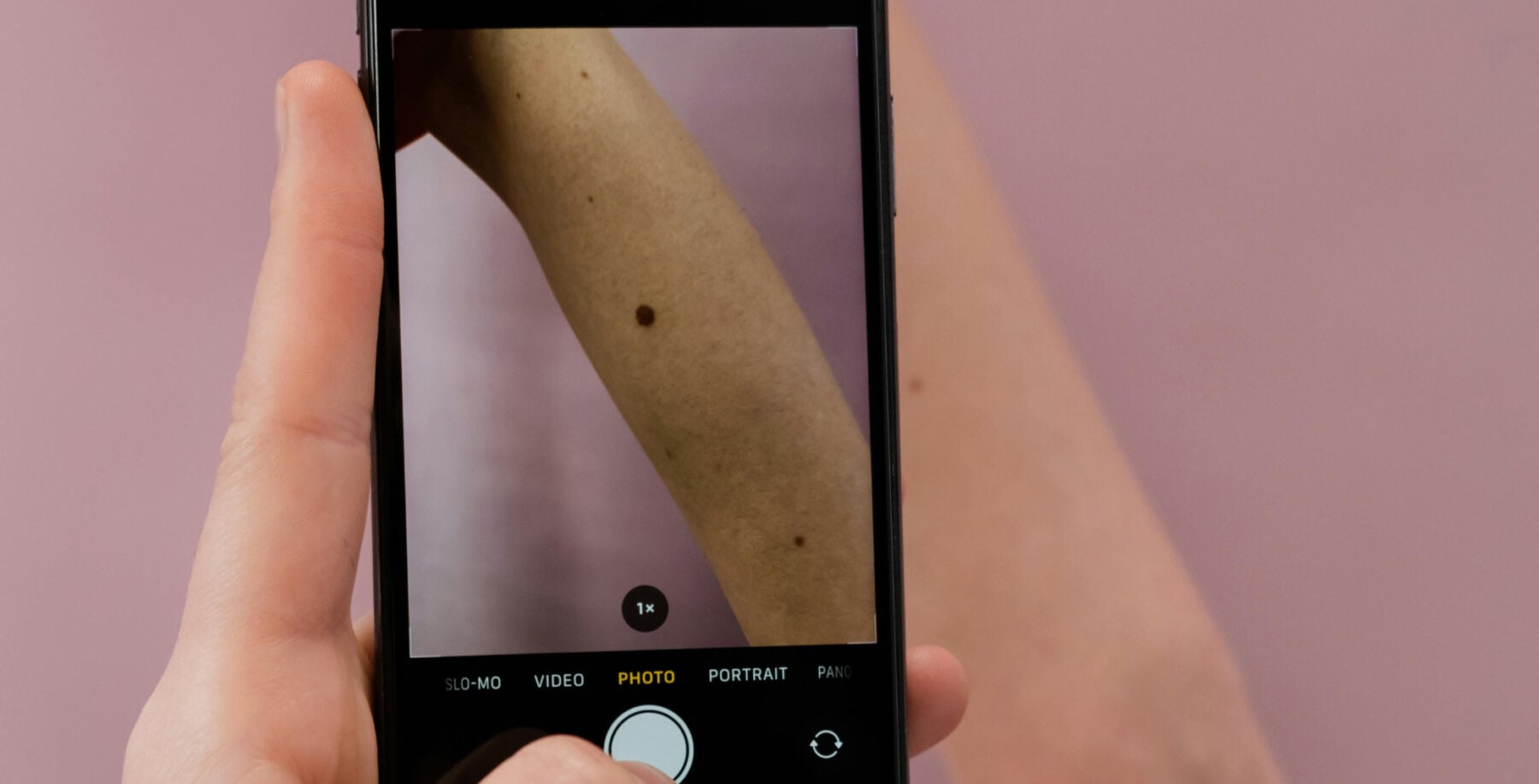 stock image of mole on skin getting a picture taken for assessment dermatology